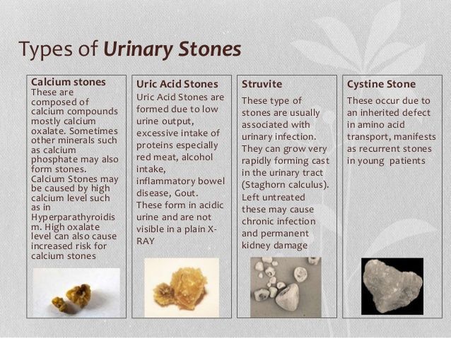 Types of Urinary Stones - MEDizzy