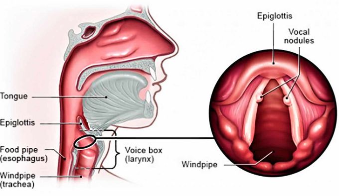 Vocal Nodules