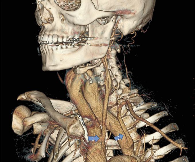 Cervical Aortic Arch