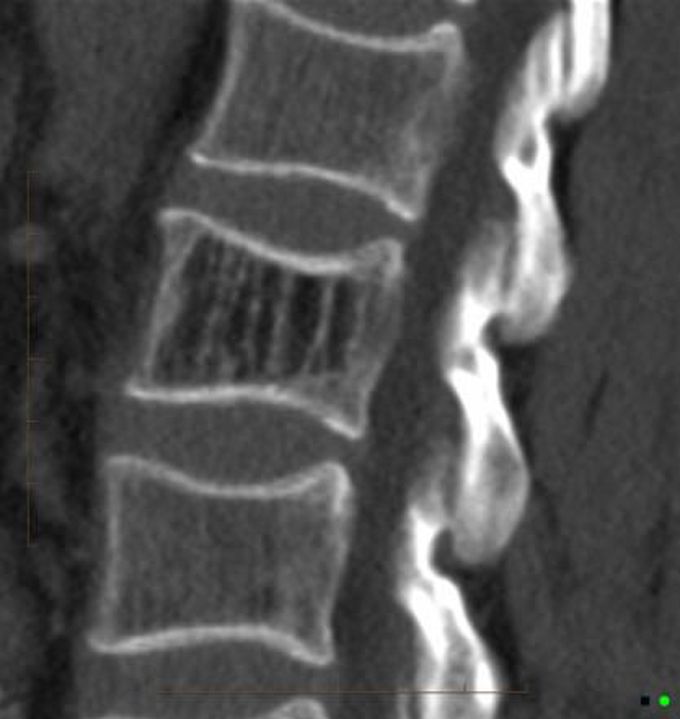 Vertebral haemangioma