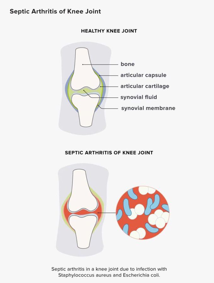 Septic Arthritis