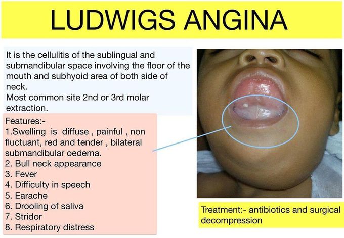 Ludwig Angina