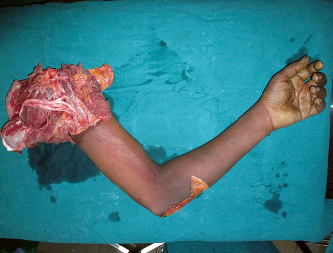 Forequarter Replantation After A Workplace-Related Injury