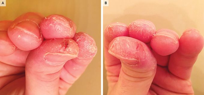 Cracked Skin of the Fingertips - Mechanic’s Hand