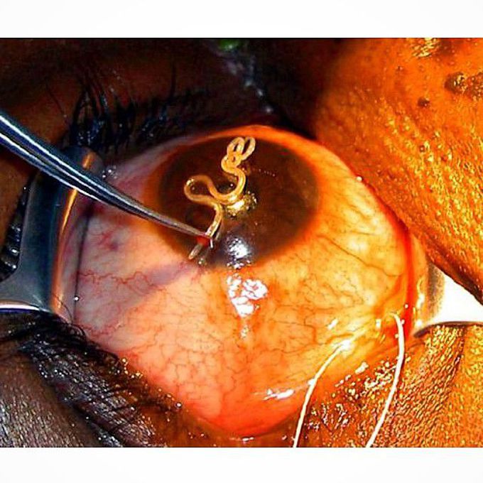 Surgical removal of a loa loa worm from the subconjunctival tissue of the eye