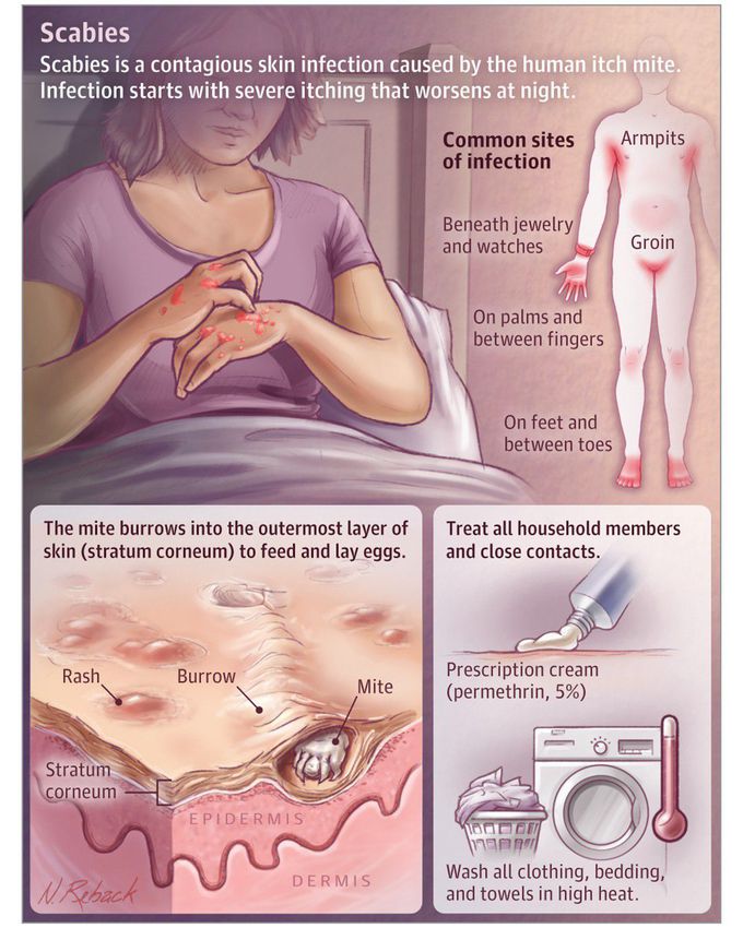 Scabies summarised