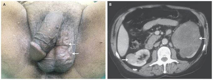 Acute Varicocele Revealing Renal Cancer