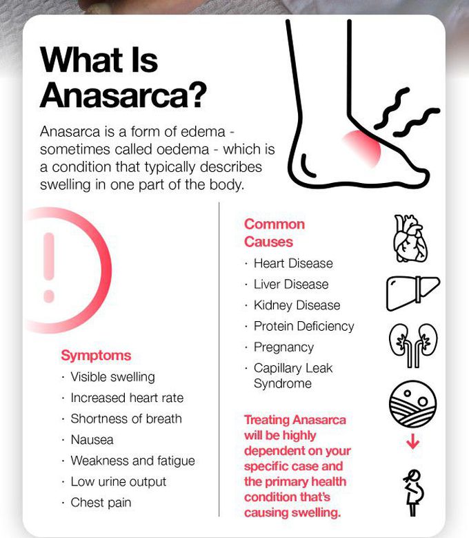 Treatment of Anasarca