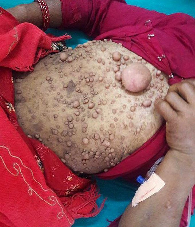 Cutaneous neurofibromas associated with neurofibromatosis