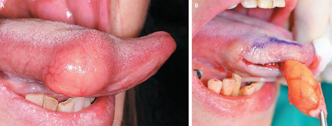 Lipoma of the Tongue
