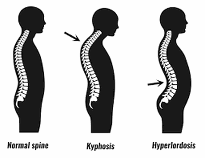 Treatment of kyphosis