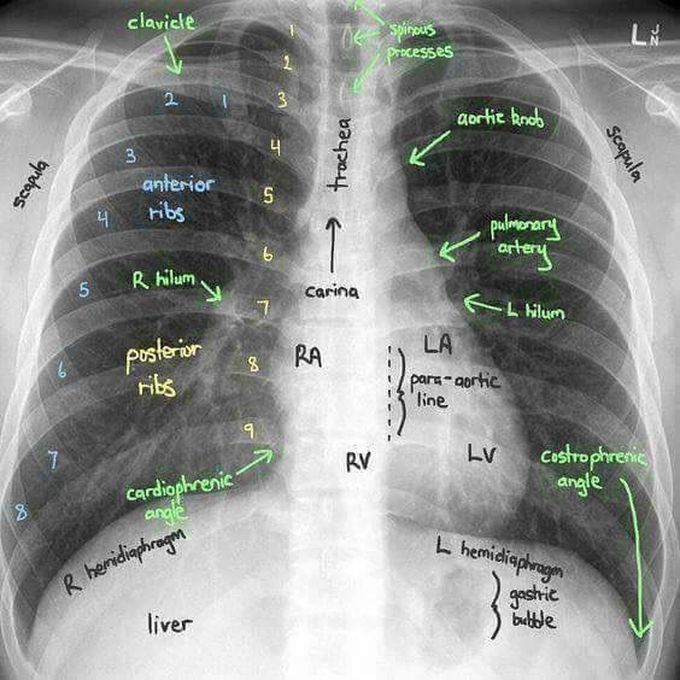 chest x-ray findings