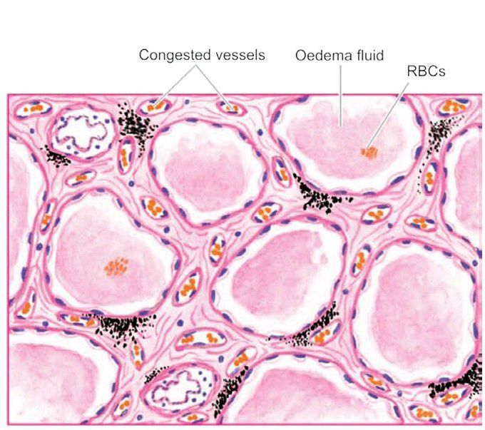 Pulmonary oedema.