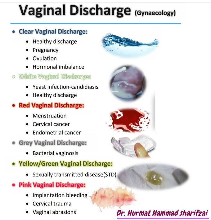 Vaginal Discharge with Itching - Aries Ob/Gyn Clinic