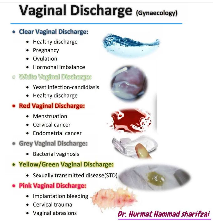 Vaginal discharge (gynecology) - MEDizzy