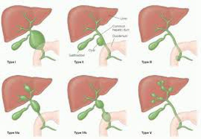 Choledochal cyst treatment