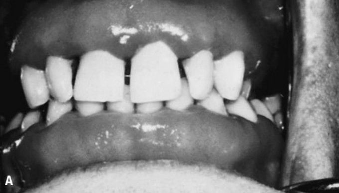 Gingival enlargement