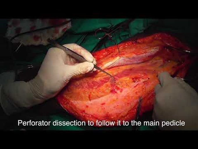 Anterolateral thigh (ALT) free flap