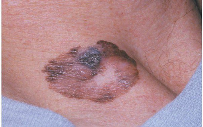 Superficial Spreading Melanoma