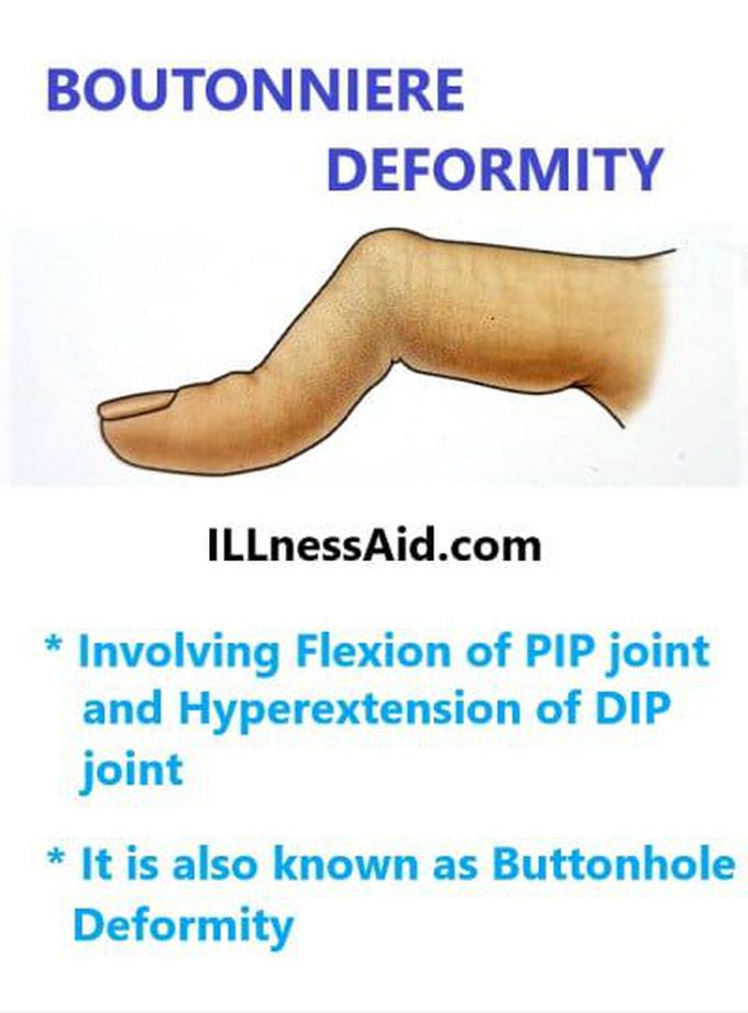 Boutonniere Deformity: Cause, Exercises, and More - ILLnessAid