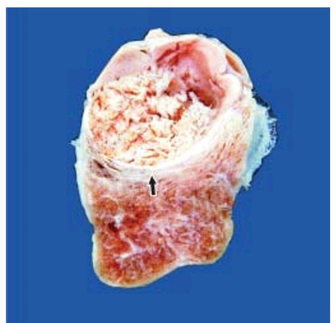 Papillary carcinoma of the thyroid.