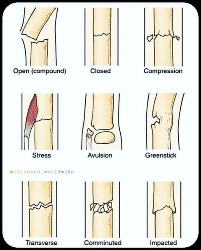 Types of Fractures