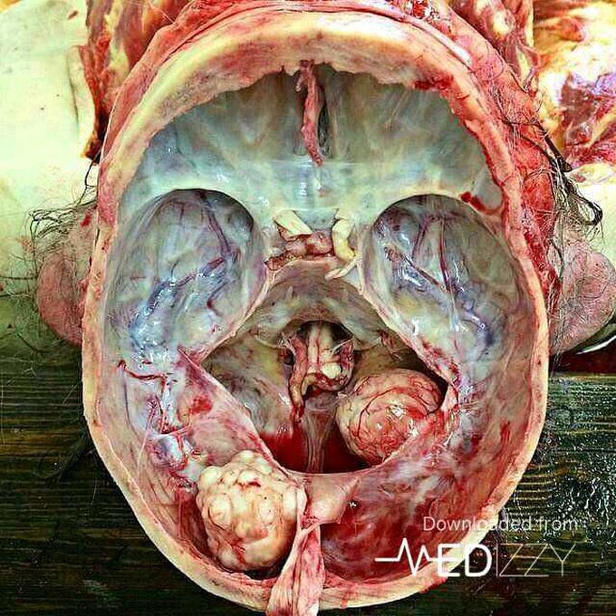 Open skull