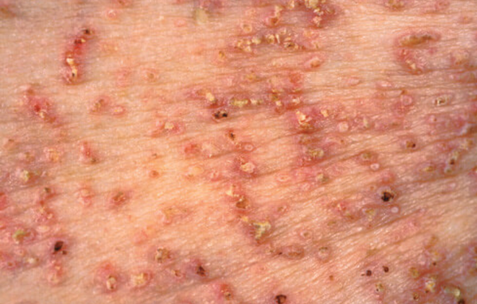 SKIN DISEASES