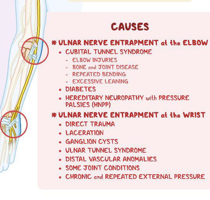 Cause of  Cubital tunnel syndrome