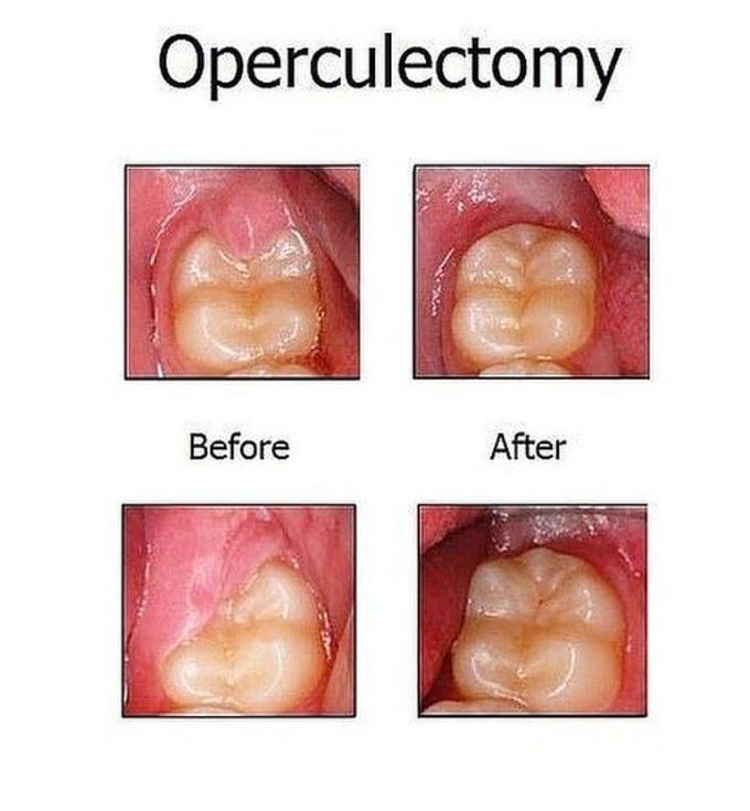 Operculectomy