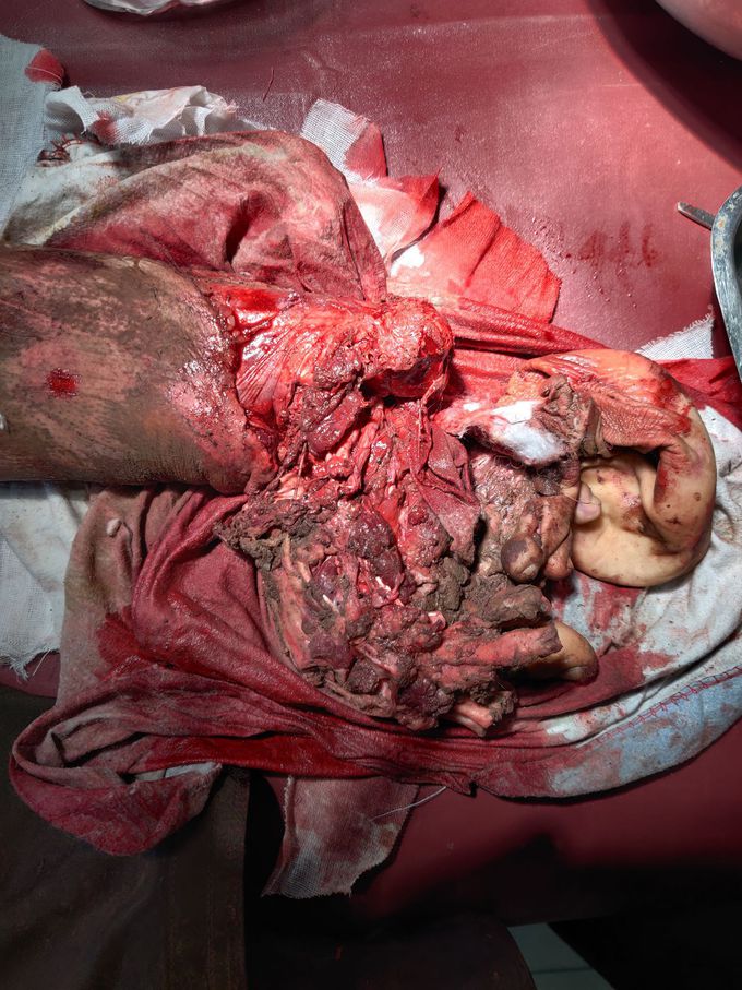 Crush Injury to foot