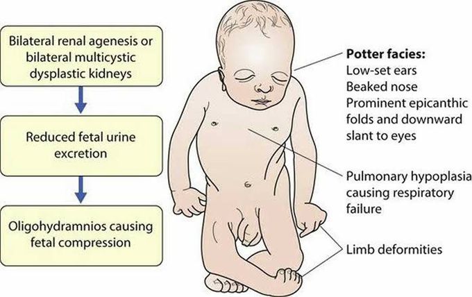 These are the symptoms of Potter Sequence syndrome