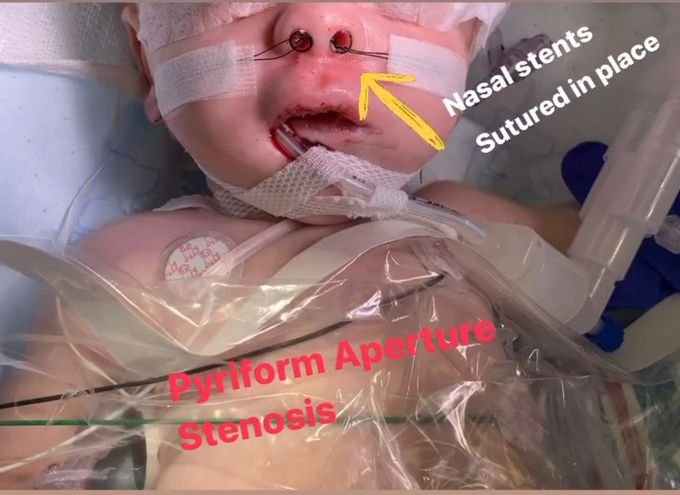 Nasal obstruction stents in infants