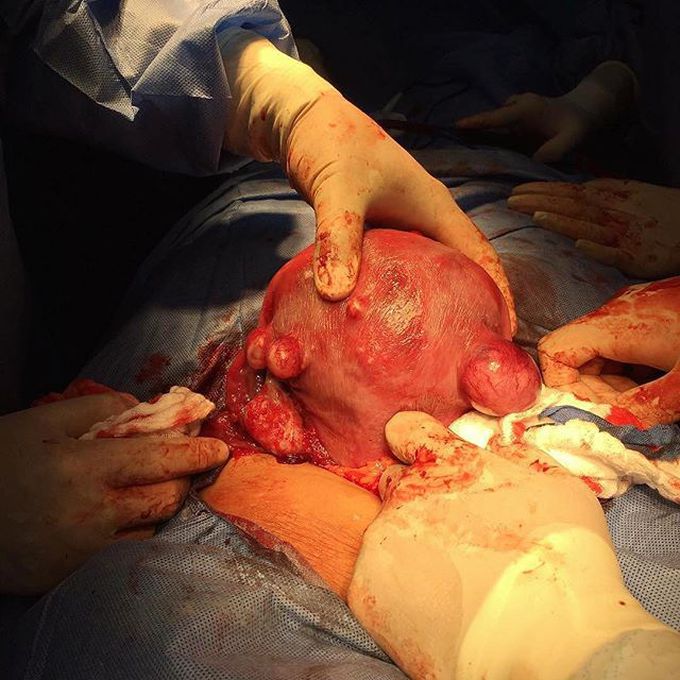 Surgical excision of uterine myomas or fibroids!