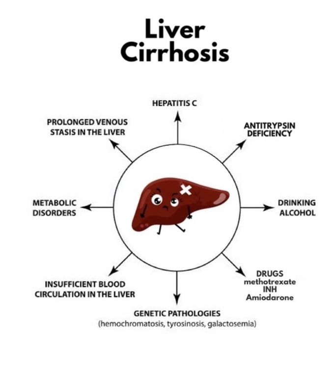 Liver Cirrhosis Highlights