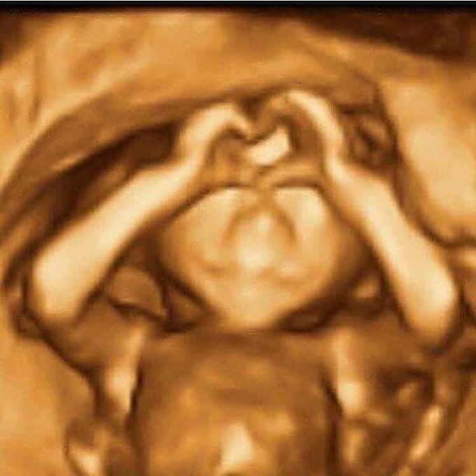 3D Ultrasound of fetus