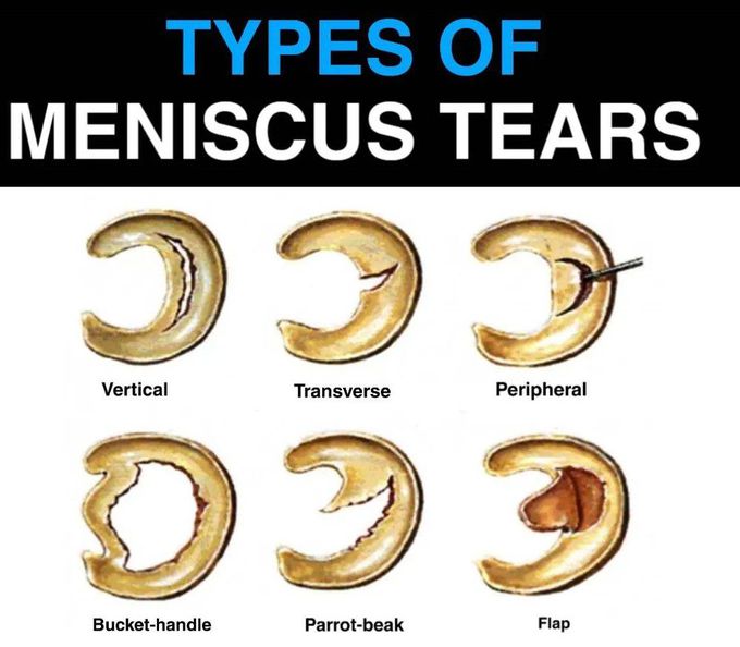 Meniscus Tears MEDizzy