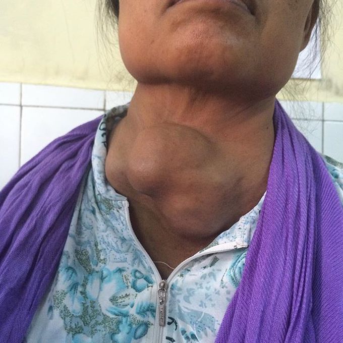 Thyroid mass