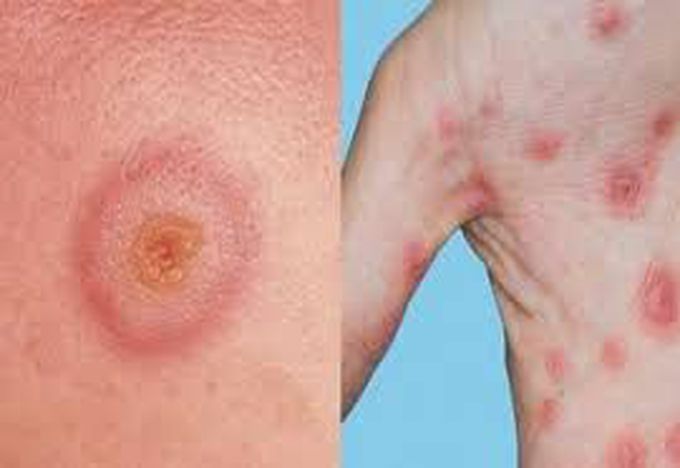 Causes of erythema multiforme