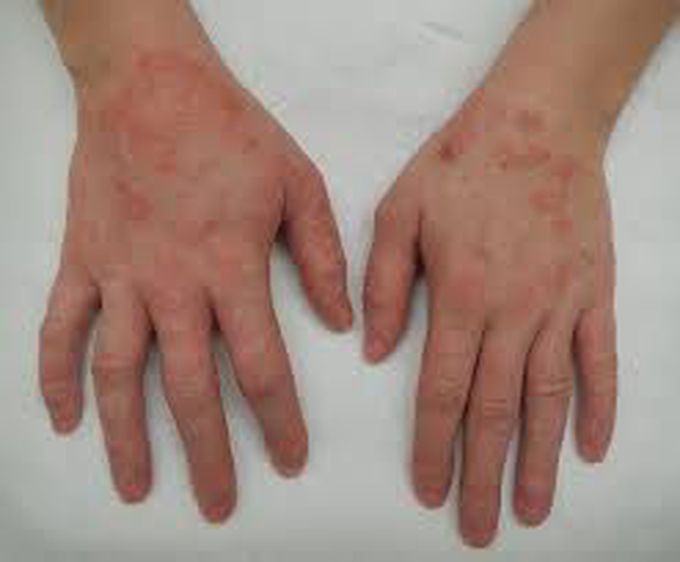 Eczema