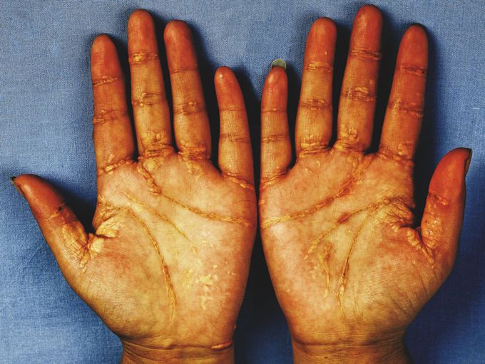 Cause of Palmar xanthoma