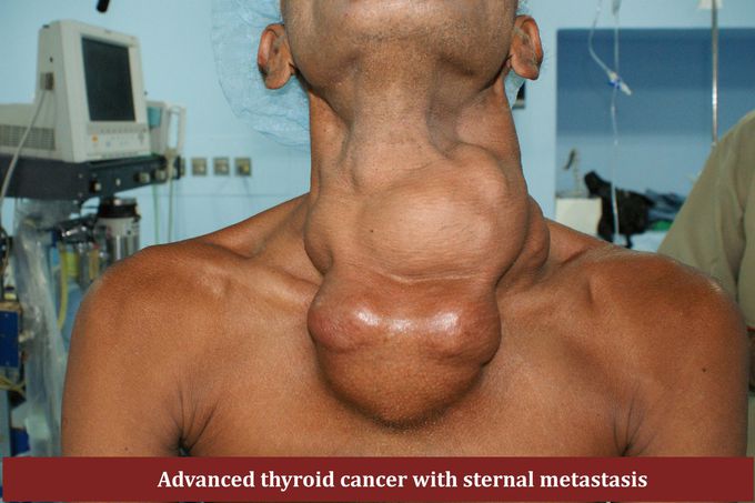 Thyroid cancer