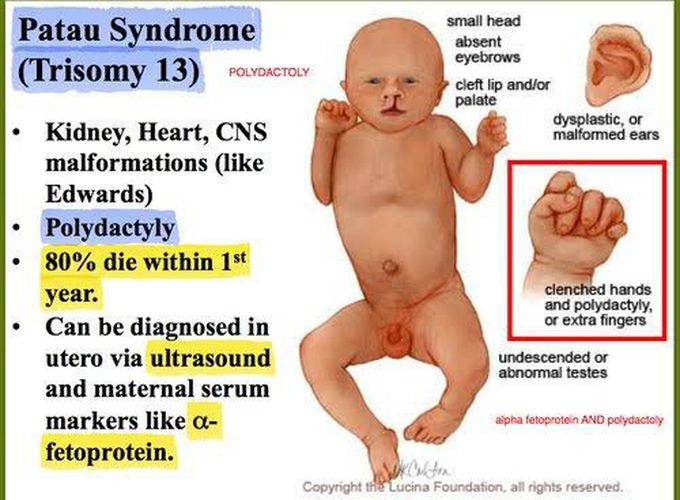 Patau Syndrome