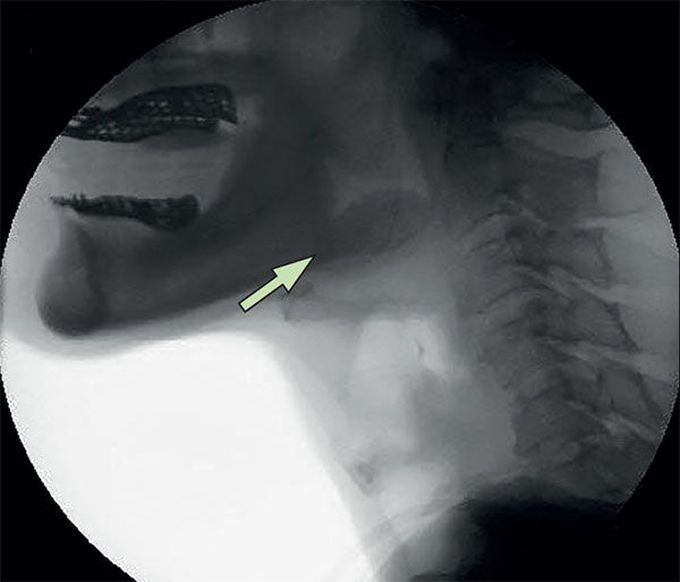 Dysphagia with aspiration symptoms