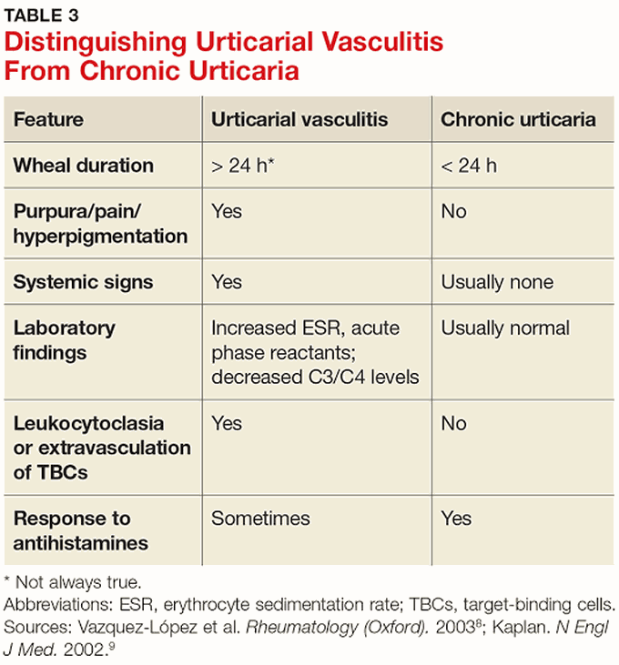 Urticarial Vasculitis and Chronic Urticaria
