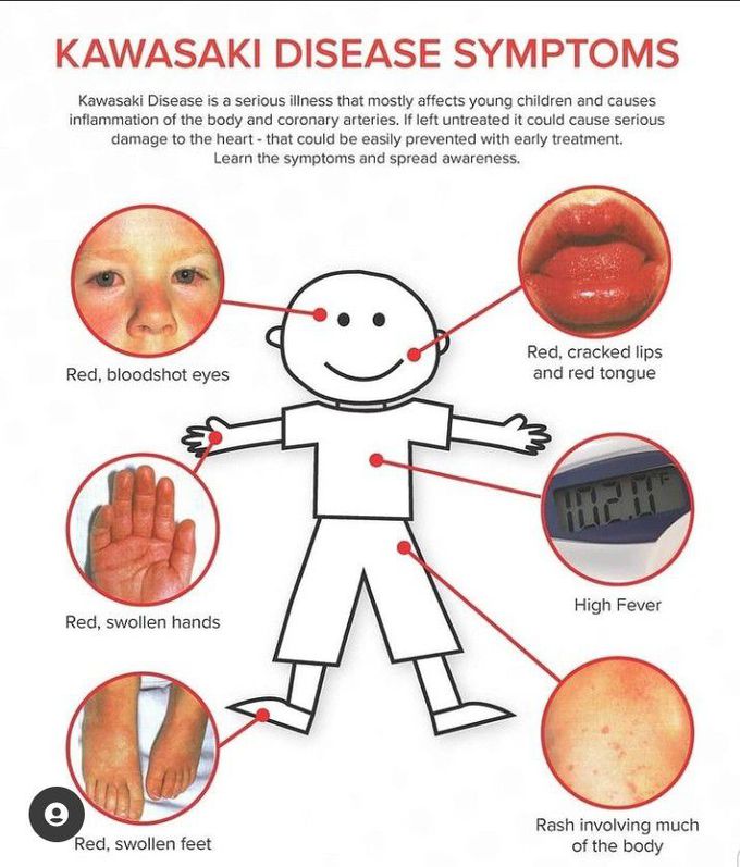 Symptoms of Kawasaki disease - MEDizzy