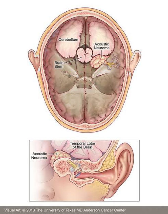 Acoustic Neuroma