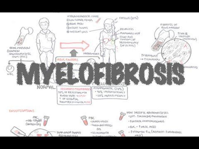 Myelofibrosis