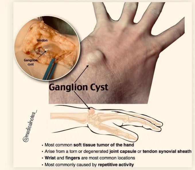 What do you know about Ganglion cyst