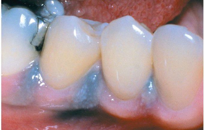 Floss-related Amalgam Implantation